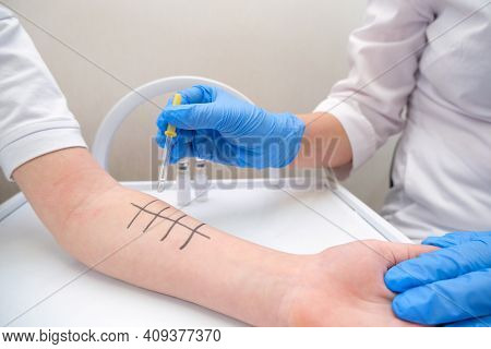 Immunologist Doing Skin Prick Allergy Test. Redness And Peeling On The Arm.