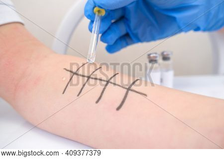 Immunologist Doing Skin Prick Allergy Test. Redness And Peeling On The Arm.