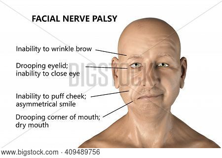 Facial Nerve Paralysis, Bells Palsy, 3d Illustration Showing Male With One-sided Facial Nerve Paraly