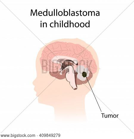 Medulloblastoma In Childhood. Brain Cancer, Tumor With Explanations.