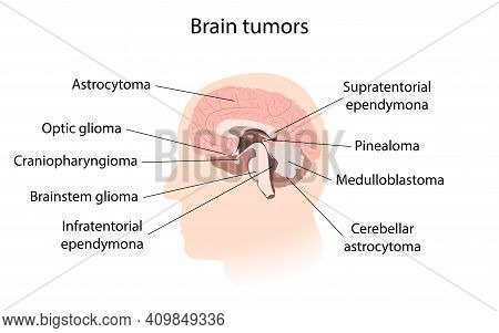 Brain Cancer, Tumor With Explanations. Sihuette Of Man Head, Inner View.
