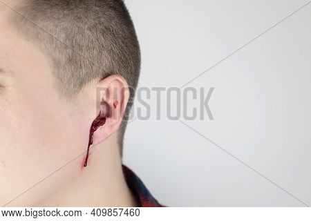 A Man Whose Ear Is Bleeding. Vascular Rupture, Damage To The Tympanic Membrane, Ear Diseases, Oncolo