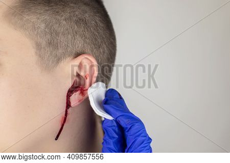 A Man Whose Ear Is Bleeding. Vascular Rupture, Damage To The Tympanic Membrane, Ear Diseases, Oncolo