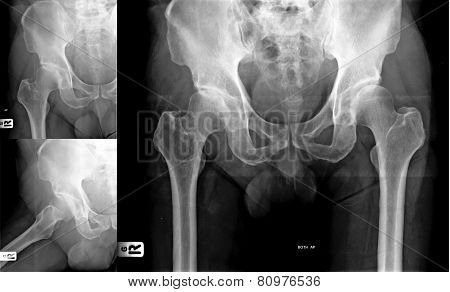 X-ray Image Of Hip
