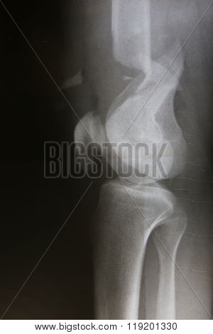 X-ray photos of bone in patient