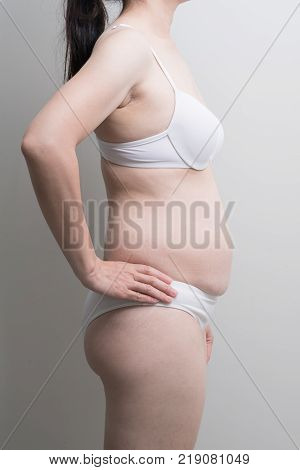 Fat overweight woman body with stretch marks after pregnancy