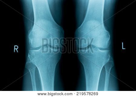 left and right knee joint X-ray image from a human body part. ideal for websites and magazines layouts