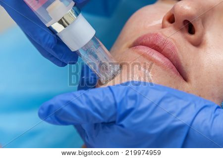 Cosmetic treatment by injection in the clinic. Use of a dermal injector to stimulate the skin. A woman receives injections of a placental-peptide serum