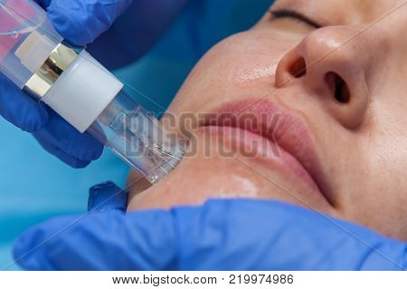 Cosmetic treatment by injection in the clinic. Use of a dermal injector to stimulate the skin. A woman receives injections of a placental-peptide serum