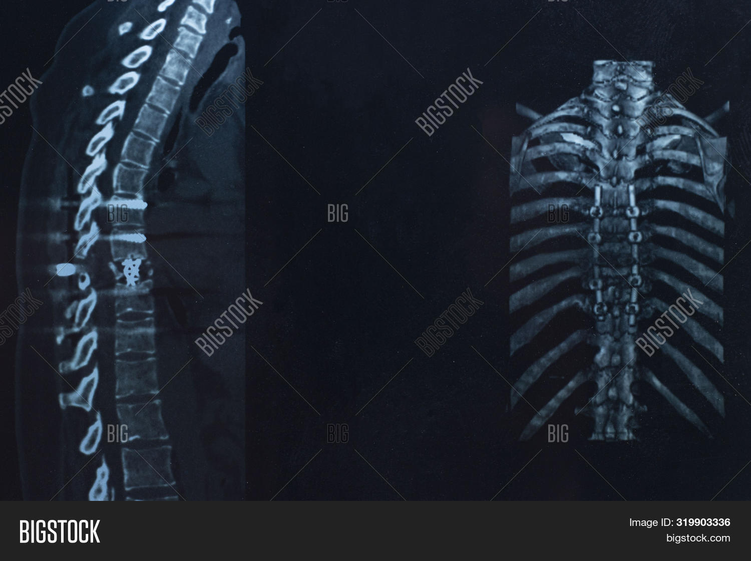 перелом позвоночника и ребер. симптомы перелома 11 и 12 ребра справа. перелом позвоночника и ребер. клинические проявления при переломе костей грудной клетки. перелом позвоночника и ребер.