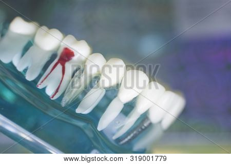 Dentist Tooth Decay Dental Model