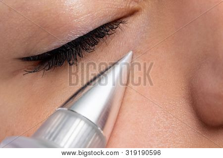 Macro Close Up Of Woman Having Noninvasive Cosmetic Facial With Plasma Pen. Cone Shaped Device Doing