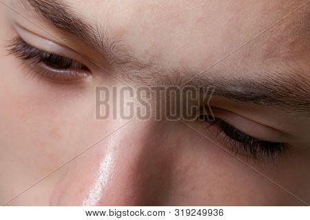 Fused Eyebrow Between The Eyes On The Nose. Preparation For The Procedure For Removing Facial Hair I