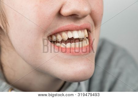 Problem Teeth At The Young Girl. A Curve Row And The Wrong Bite An Occasion To Visit The Dentist And