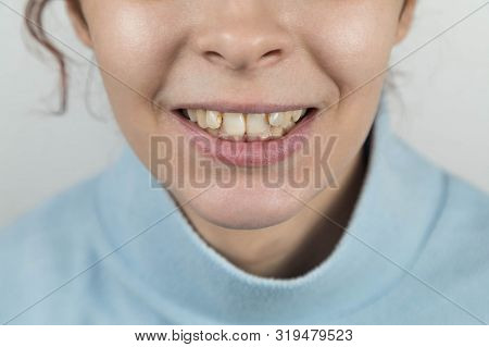 Problem Teeth At The Young Girl. A Curve Row And The Wrong Bite An Occasion To Visit The Dentist And