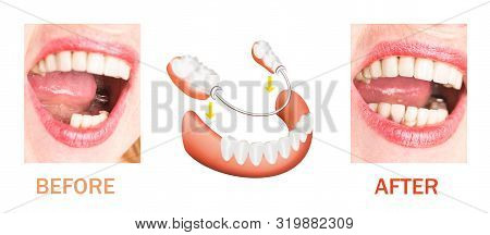 Dental Rehabilitation With Lower Flexible Nylon Denture, Before And After Treatment. Removable Dentu