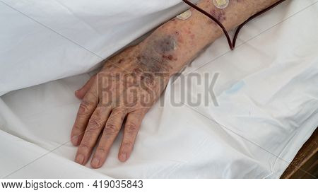 Ankara, Turkey - March 2021: Arm Of An Old Person With Bruises Receiving Blood Transfusion Serum In 