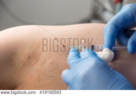 Surgeon Gives Injection Of Local Anesthesia Before Laser Removing Of Papillomas.