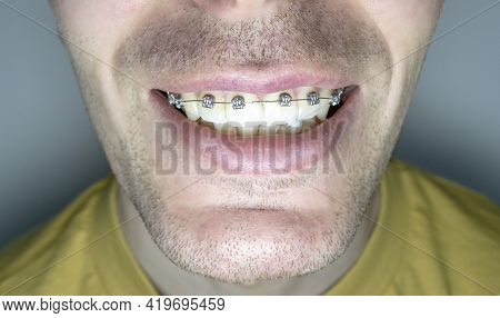 Smiling Man With Braces On The Teeth Of The Upper Jaw