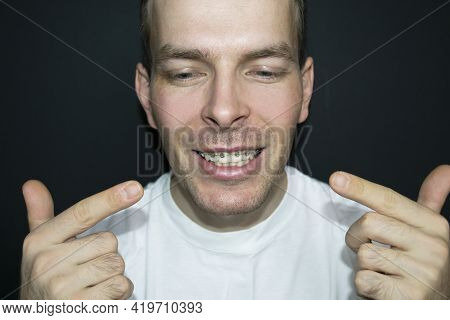 Mans Smile With Braces On The Teeth Of The Upper Jaw