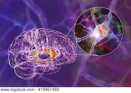 Destruction Of Neurons Of The Caudate Nucleus, Conceptual 3d Illustration. Caudate Nucleus Belongs T