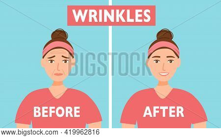 Woman Face Wrinkles Before And After Skin Care Treatment In Flat Design. Anti-aging Therapy.