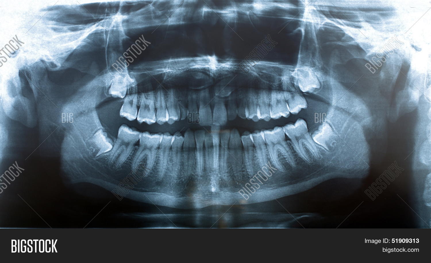 Picture Xray Jaw Image & Photo (Free Trial) Bigstock