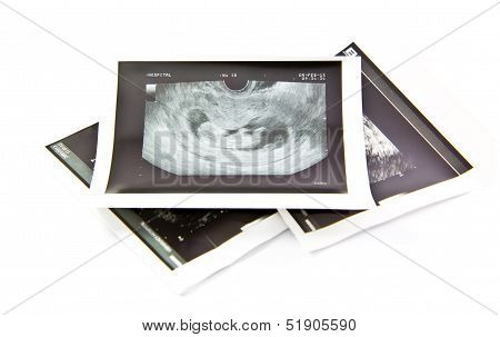 12 Weeks Baby Ultrasound Image