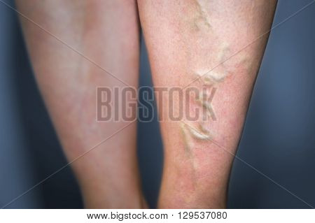 Thrombophlebitis In Human Leg