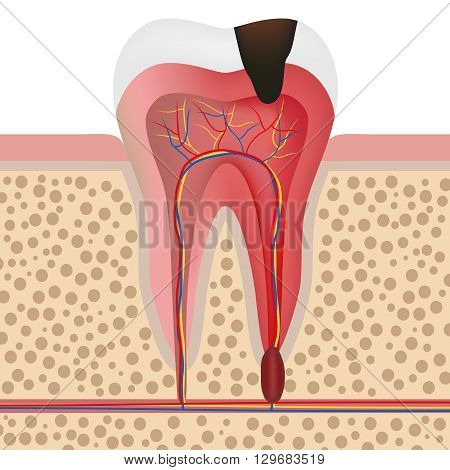 Vector illustration showing infected tooth with pulpitis.