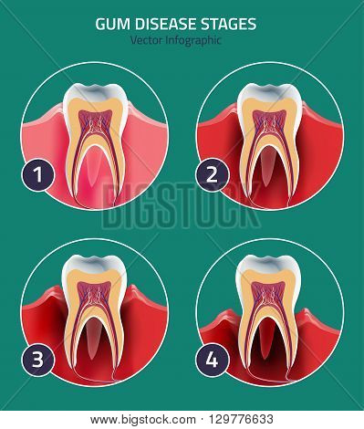 Gum disease stages. Editable vector illustration in modern style. Medical concept in natural colors on a light green background. Keep your teeth healthy
