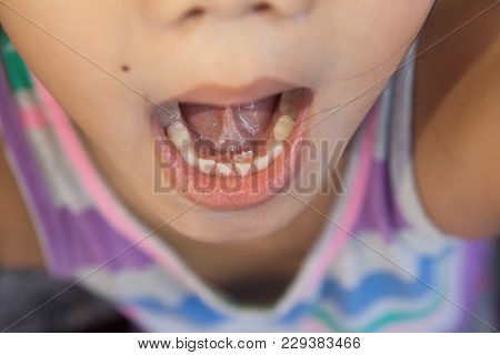 Adult Permanent Teeth Coming In Behind Baby Teeth
