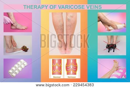 Collage About Therapy Or Treatment Of Varicose Veins