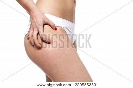 Stretch Marks On Woman's Buttocks