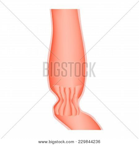 Lower Cardiac Esophageal Sphincter. Infographics. Vector Illustration On Isolated Background