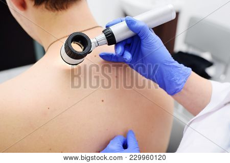 The Doctor Dermatologist Examines Birthmarks And Birthmarks Of The Patient With A Dermatoscope. Prev