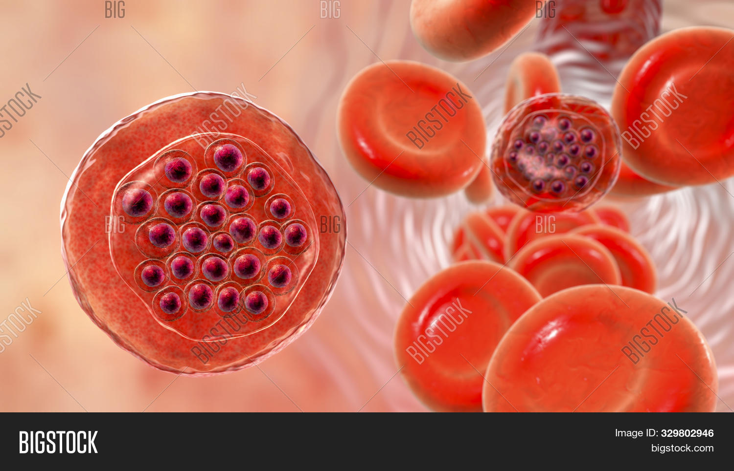 Infected Rbc Malaria-infected Red Image & Photo (Free Trial) | Bigstock