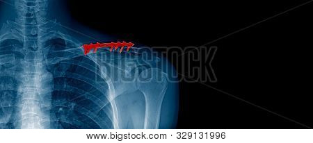 X-ray Image And Banner Design Of Shoulder In Blue Tone With Black Background