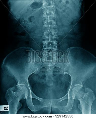 Old Man X-ray, Lumbar X-ray Image With Pelvic Bone In Blue Tone