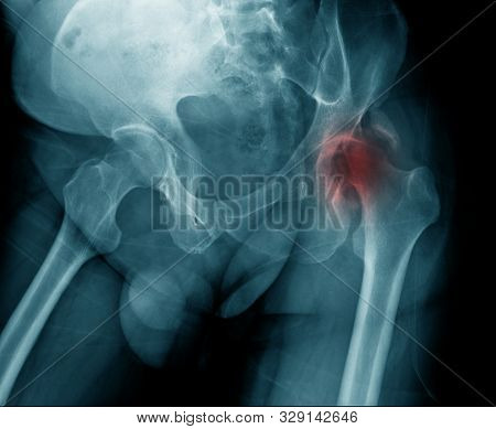 X-ray Image Of Old Woman Show Degenerative Change Of Hip Joint, Hip Avascular Necrosis Right Side Of