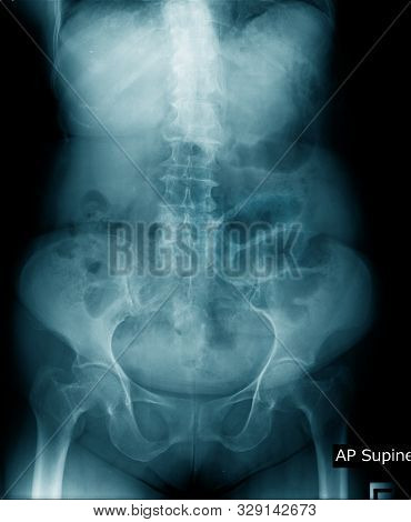 Old Man X-ray, Lumbar X-ray Image With Pelvic Bone In Blue Tone