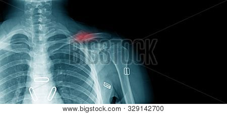 X-ray Clavicle Fracture, Accident Of Old Man At Shoulder Part