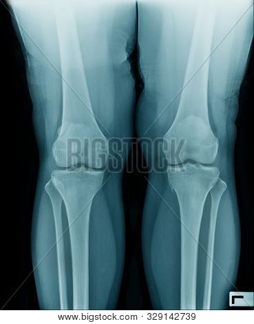 High Quality X-ray Knee Joint Of Old Man, Oa Knee Of Old Man On Black Background In Blue Tone