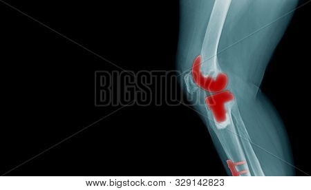 X-ray Image Of Oa Knee With Banner Design, Tka X-ray Image