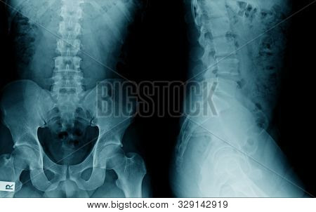 Lumbar Spondylosis X-ray Image Ap And Lateral View