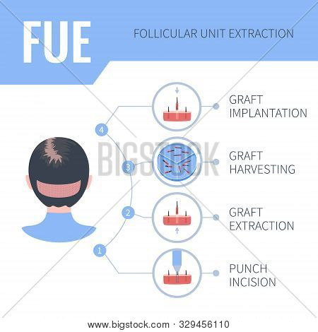 Fue Hair Transplantation Medical Infographics For Women