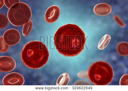 The Malaria-infected Red Blood Cell. 3d Illustration Showing Parasite Plasmodium Malariae In The Sta