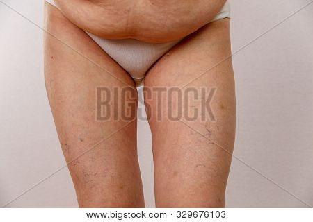 An Elderly Woman In White Panties Shows The Folds On Her Abdomen On A White Isolated Background.
