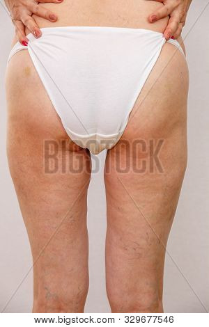 Elderly Woman In White Panties Shows Cellulite And Varicose Veins On A Light Isolated Background. Co