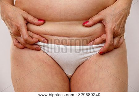 An Elderly Woman Lowers Her Underwear And Shows The Scar From The Operation